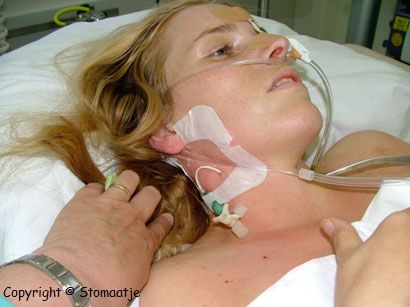 ongetunnelde versie in de hals van de subclavia